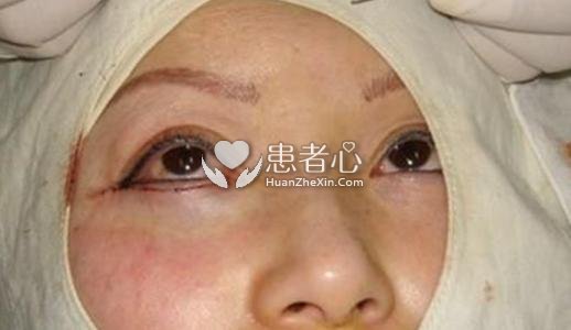 年轻姑娘在深圳百合医院做眼袋手术 不料术后痛苦不堪