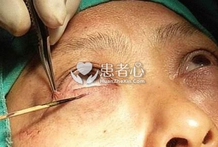 年轻姑娘在深圳百合医院做眼袋手术 不料术后痛苦不堪