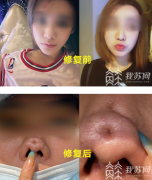 女子在南京智颜整形做隆鼻修复 结果面目全非不能见人！